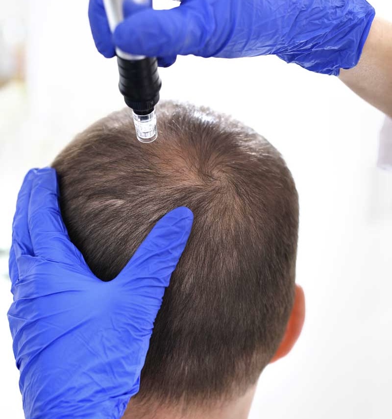 Opción #6: Dermapen capilar